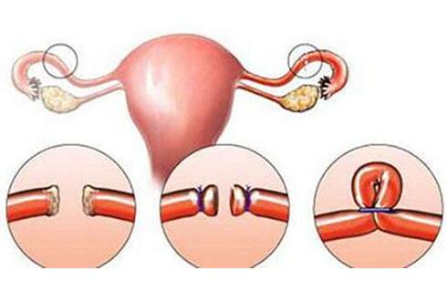 什么是输卵管堵塞？输卵管堵塞可以做试管婴儿吗？