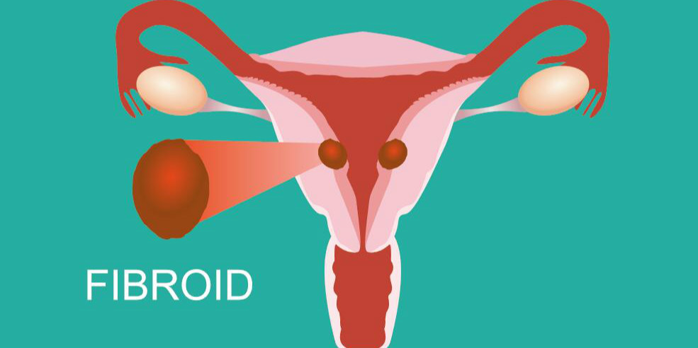 什么是子宫肌瘤？子宫瘤是怎么造成的？