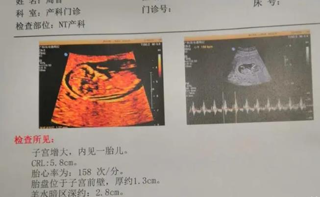 nt值为1.1mm是更容易生男孩还是女孩？