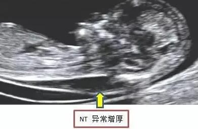 nt值看男女有科学依据吗？判断成功率高不高？