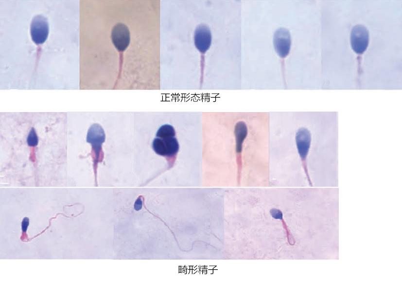 精子畸形怎么检查，如何治疗？