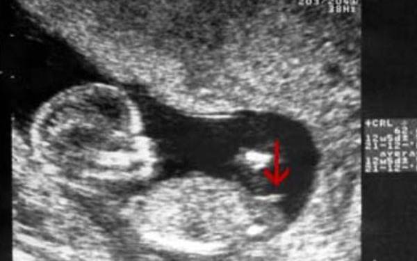 婴儿13周如何看NT图辨别男女？三个特征告诉你