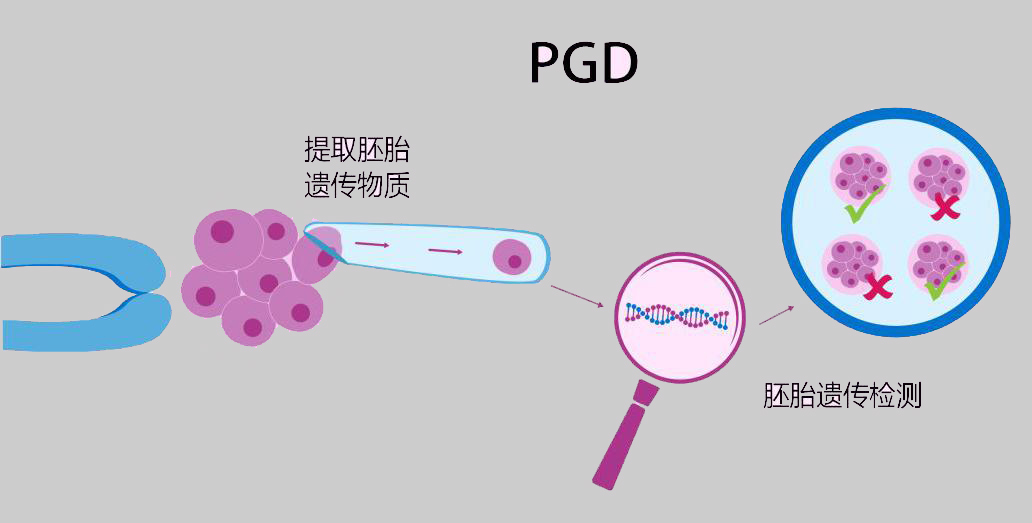 胚胎植入前遗传学诊断(PGD)