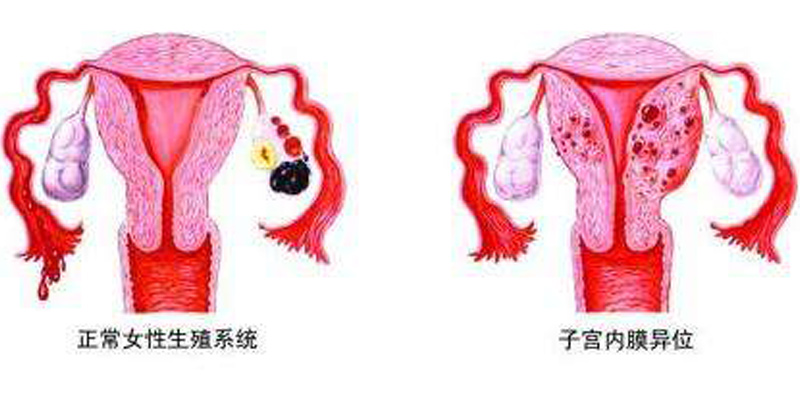 子宫内膜异位的诊断和治疗