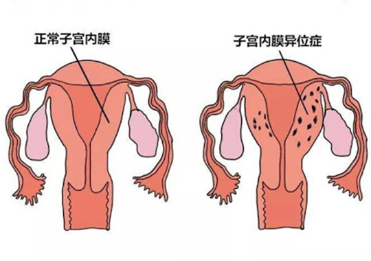 子宫内膜异位症的症状和不孕症