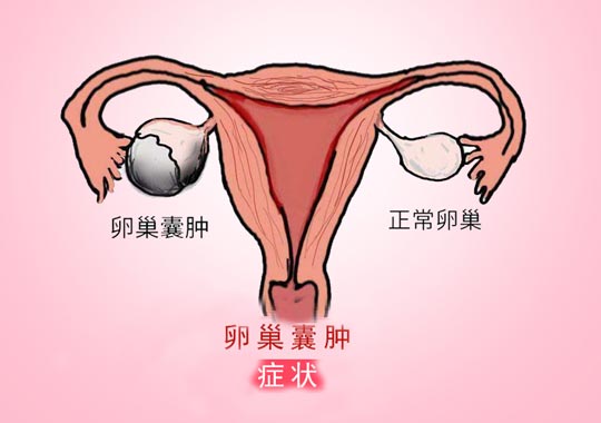 卵巢囊肿有什么症状？