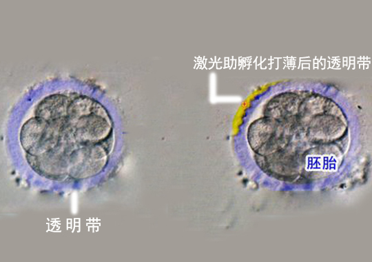 胚胎激光辅助孵化