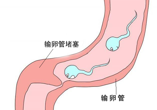 输卵管因素不孕症的诊断和治疗