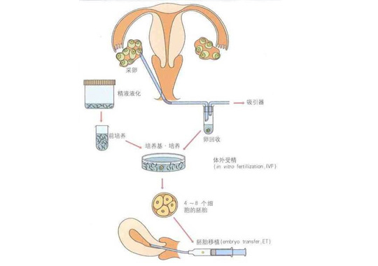 试管婴儿适应症：第一代试管婴儿(IVF)