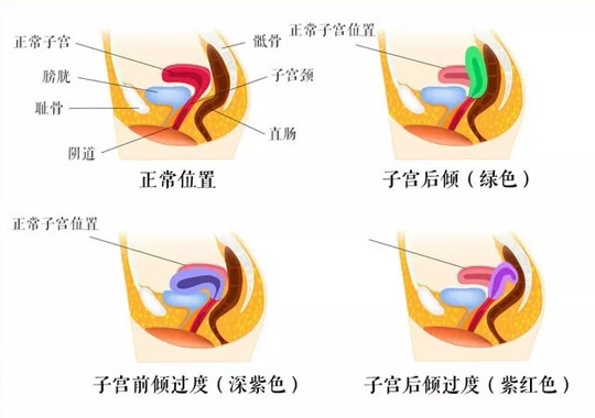 子宫后位是什么意思