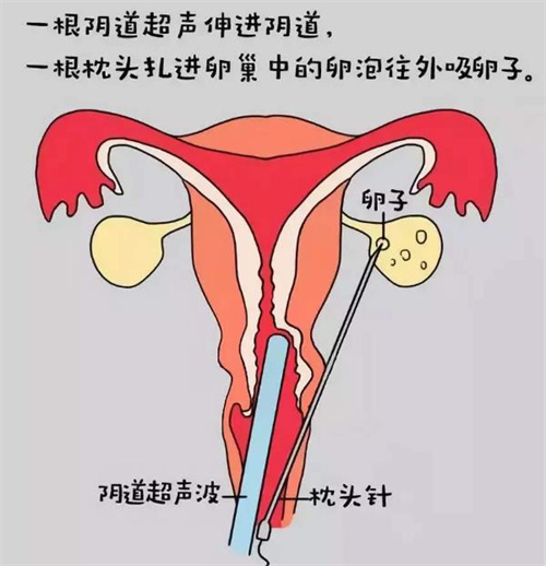 女性卵巢早衰可以通过试管助孕生孩子吗？卵巢早衰做供卵试管成功率有多少