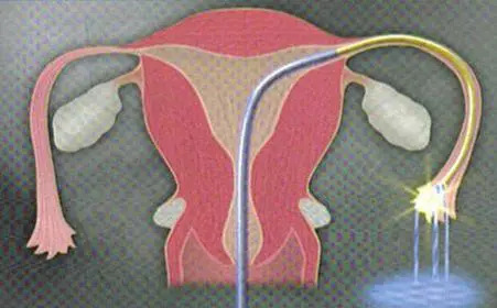 盆腔腹膜炎影响怀孕吗?盆腔腹膜炎可以治愈吗？