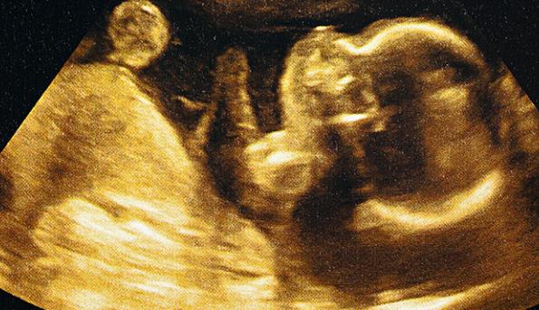 四维彩超判断胎儿性别怎么看最准确？