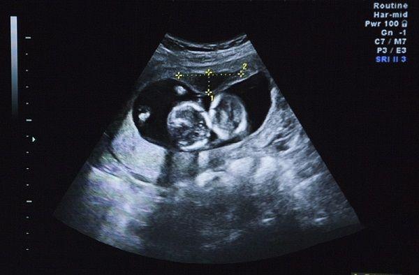 胎宝宝打嗝的位置在哪，是头还是胸，要如何判断？