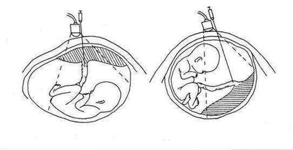 1分钟了解胎盘前壁和后壁的3大区别，为孕期做好准备