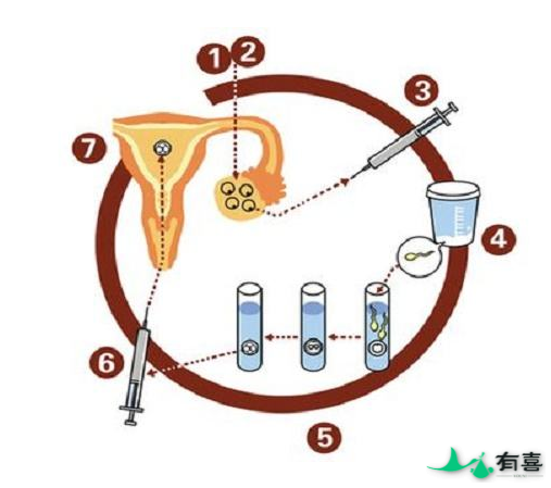 柬埔寨试管婴儿详细流程介绍（助力二胎）