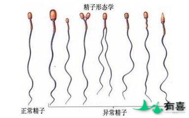 精子畸形偏方:如何改善99%精子畸形患者？