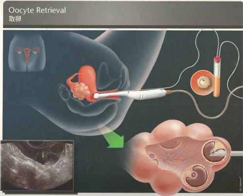 为什么试管婴儿取卵多培育出的胚胎少？卵子质量问题很关键