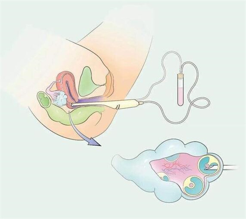 不同移植方案适合不同患者！附试管婴儿冷冻胚胎的4种移植方案
