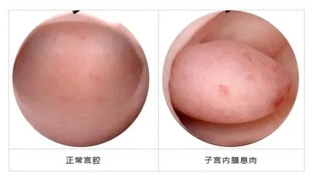 宫腔积水和粘连,做泰国试管先取卵还是先手术?插图 宫腔积水和粘连,做泰国试管先取卵还是先手术?插图