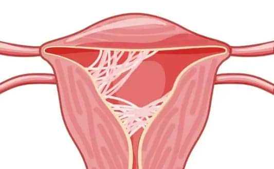 宫腔积水了别慌，咱们一步步来插图