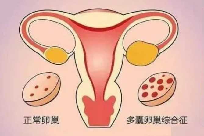 宫腔积水能做试管婴儿吗？先处理积水再考虑试管插图