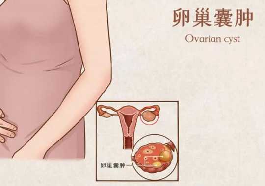 卵巢囊肿的类型有哪几种?插图