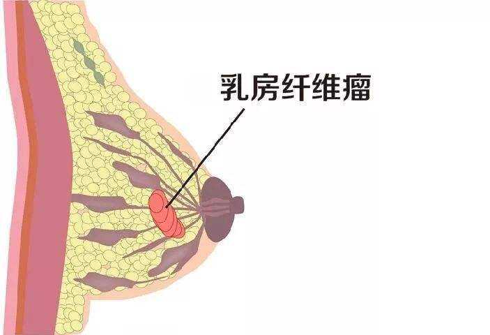 乳腺纤维瘤会影响怀孕吗？插图