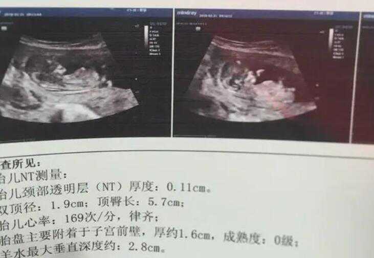 nt值看男孩女孩诀窍是什么？nt分辩性别方法插图