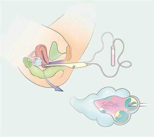 试管取卵17天同房有没有影响？取卵17天还没来大姨妈是怎么回事插图