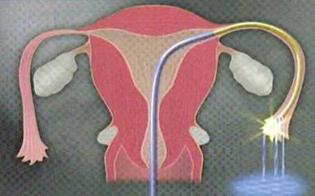 盆腔腹膜炎影响怀孕吗?盆腔腹膜炎可以治愈吗？插图