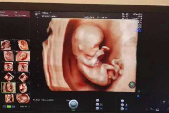 四维彩超如何判断性别？四维单子上生男孩标志是怎样的？插图