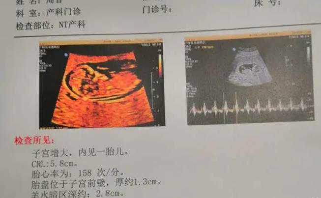 nt值为1.1mm是更容易生男孩还是女孩？插图1