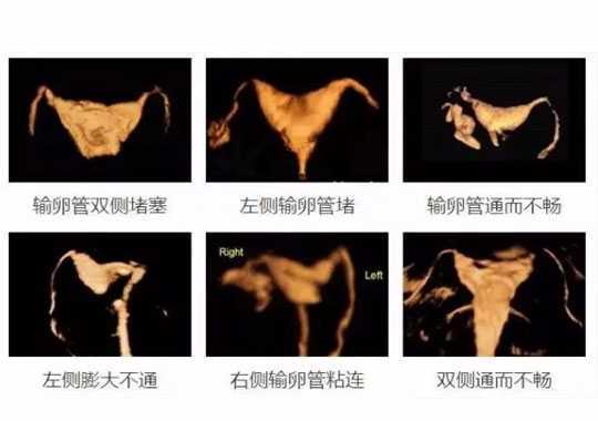 什么情况要做输卵管造影?插图