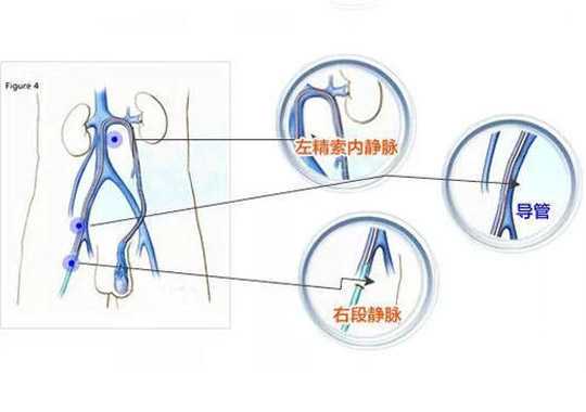 那些精索静脉曲张患者可以手术治疗?插图 那些精索静脉曲张患者可以手术治疗?插图