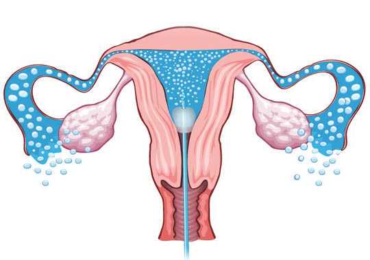 输卵管堵塞能治疗吗?插图 输卵管堵塞能治疗吗?插图