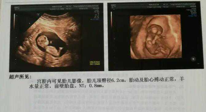 12周nt男宝特点？一眼判断nt男宝方法插图2