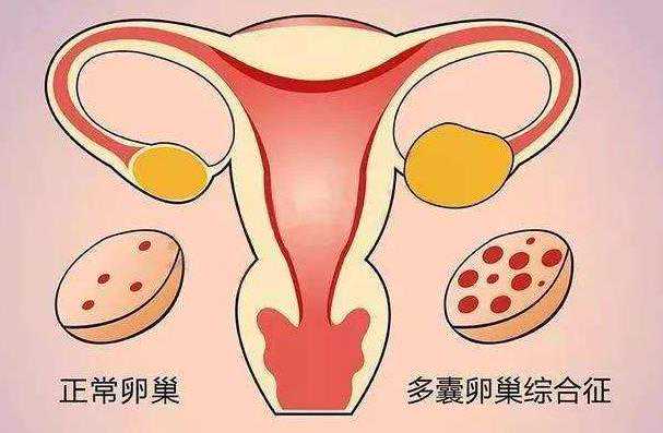 多囊患者做试管婴儿要注意什么?多囊患者可以做试管吗?插图 1657088822674656.jpeg