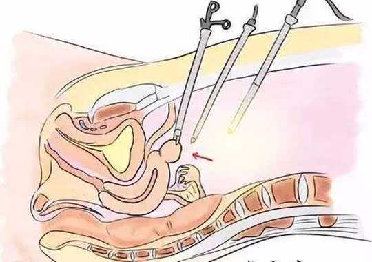 什么情况需要做腹腔镜?插图 什么情况需要做腹腔镜?插图