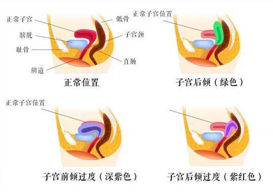子宫后位是什么意思插图 子宫后位是什么意思插图