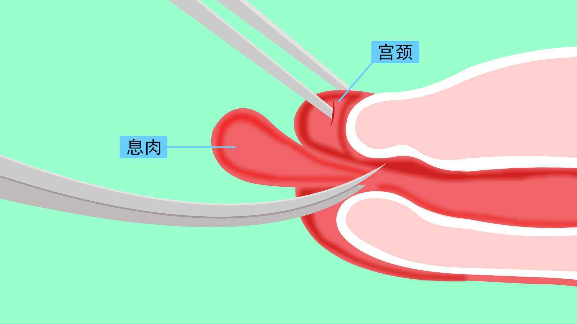 患有宫颈息肉可以做试管婴儿吗？插图