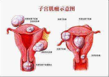 子宫肌瘤的治疗费用是多少钱?子宫肌瘤症状表现有哪些?插图 1657089055173879.jpeg