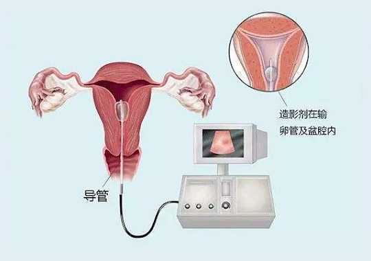 造影是什么?插图