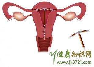 女性取环后出血取环后出血几天算正常插图 女性取环后出血取环后出血几天算正常插图
