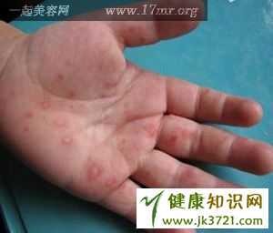 手口足病的预防插图 手口足病的预防插图