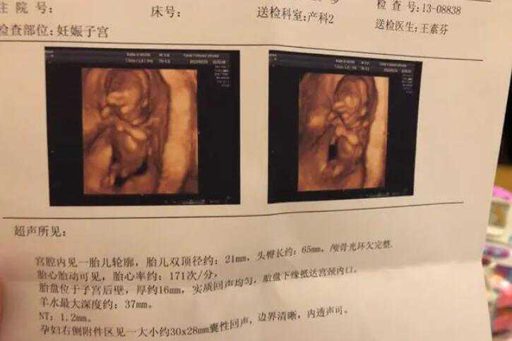 nt值看男孩女孩诀窍是什么？nt分辩性别方法插图1