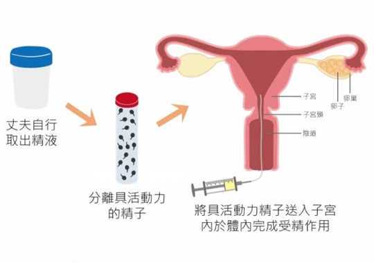 人工受孕插图