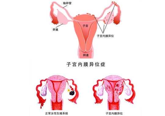 子宫内膜异位症插图 子宫内膜异位症插图