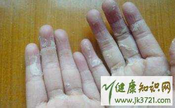 宝宝手指脱皮怎么办如何预防手指脱皮插图1