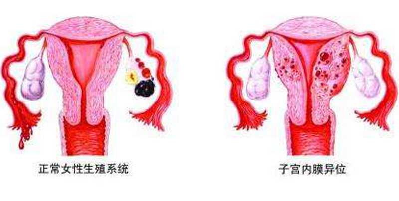 子宫内膜异位的诊断和治疗插图 子宫内膜异位的诊断和治疗插图